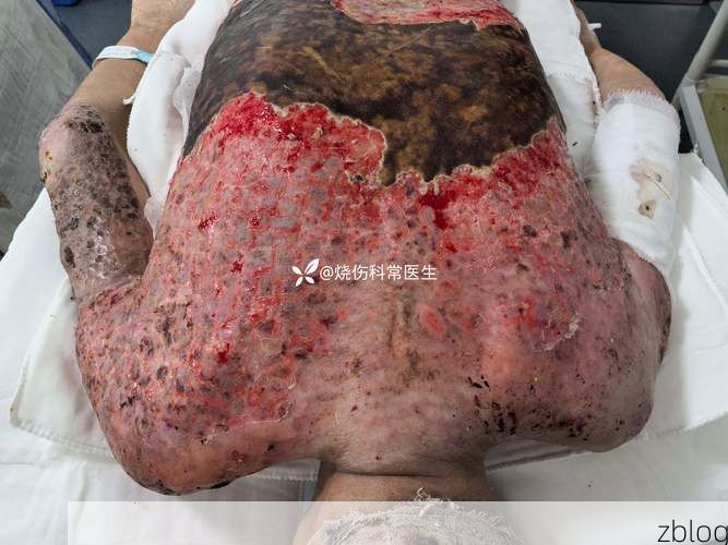 楚雄：滇中高原屏障下的低感染样本