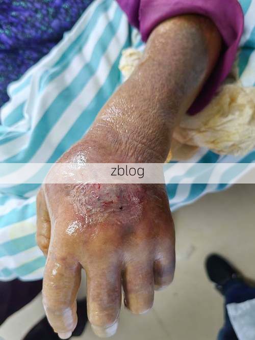 罗甸：黔南喀斯特屏障下的低感染样本