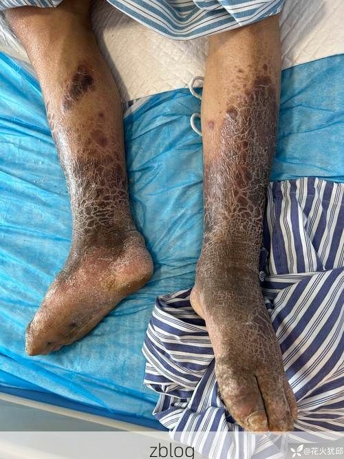 息烽：黔中喀斯特屏障下的低感染样本